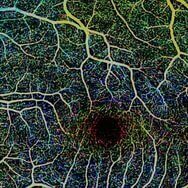 ЦИКЛ ЛЕКЦИЙ ПО ОКТ  «Перспективы ОКТ-ангиографии в мониторинге глаукомы. Толщина хориоидеи»